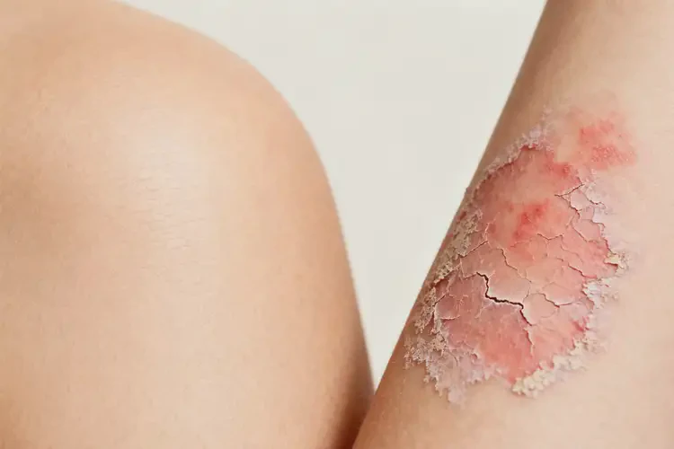 女性身上經(jīng)常長濕疹不管它會自己自愈嗎(圖1)