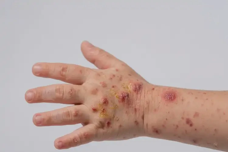 小孩手上長濕疹不管它會(huì)自己好嗎(圖2)