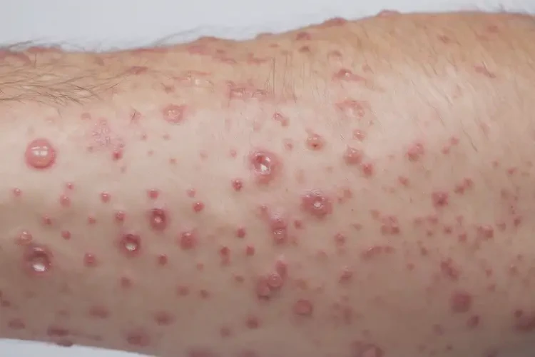 男性手臂偶爾起濕疹可以徹底自愈嗎(圖4)