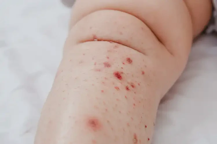 嬰兒大腿出濕疹可以徹底自愈嗎(圖4)