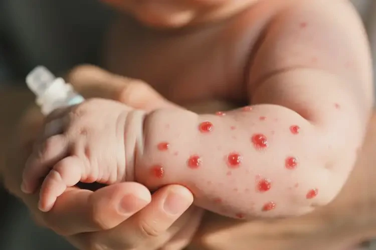 嬰兒手臂起濕疹不管它會自己痊愈嗎(圖4)