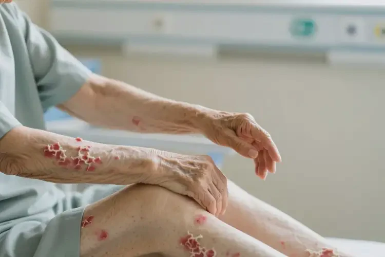 老人四肢出現(xiàn)濕疹不管它會自己好嗎(圖1)