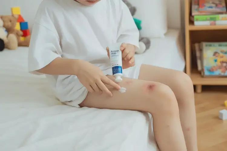 兒童小腿上起濕疹可不可以徹底自愈(圖2)