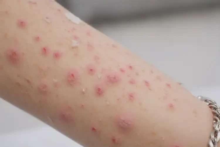 哺乳期妈妈四肢起湿疹不管它会自己好吗(图4)