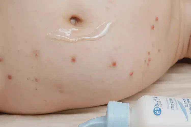 幼兒肚子上容易長濕疹可不可以徹底自愈(圖2)