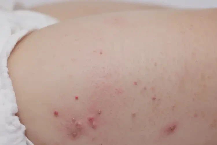 嬰幼兒大腿上長濕疹能夠徹底治愈嗎(圖4)