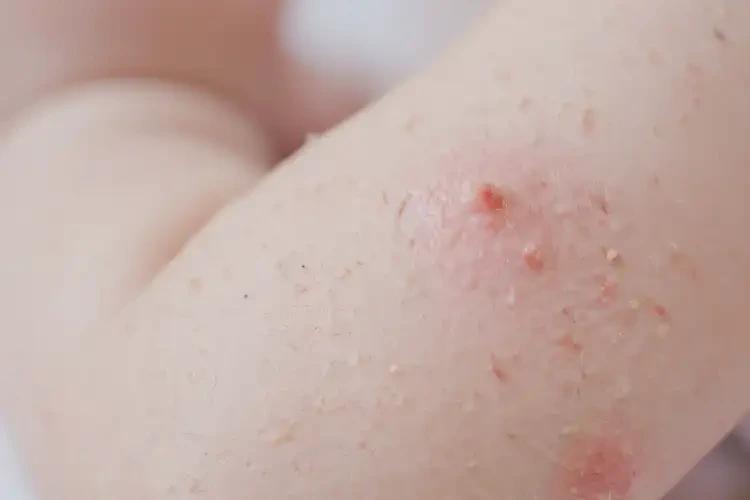 寶寶手臂出現(xiàn)濕疹能夠徹底治愈嗎(圖4)