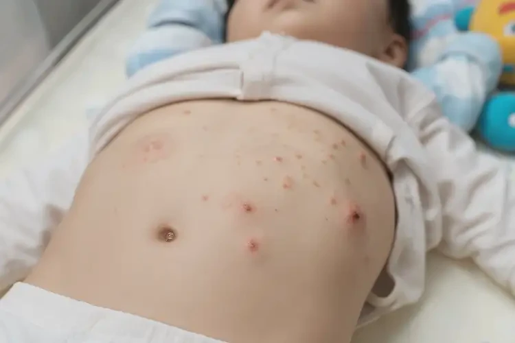 幼兒肚子上偶爾起濕疹能靠自己自愈嗎(圖4)