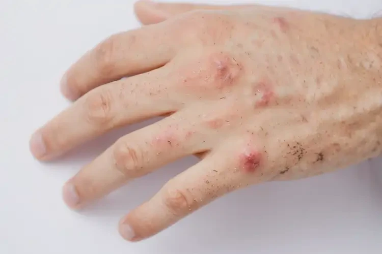 青年人手上容易起濕疹不管它會(huì)自己好嗎(圖4)