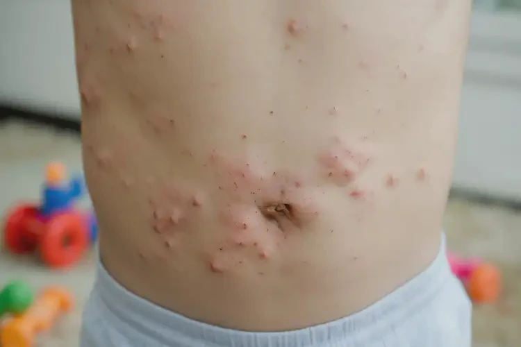 兒童肚子上出濕疹能徹底自愈嗎(圖4)