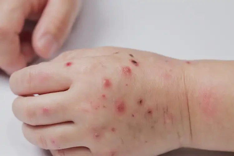 小孩手上有濕疹可不可以徹底自愈(圖4)