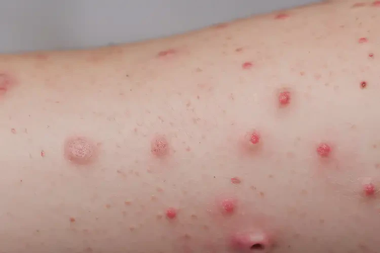 孩子手臂容易長(zhǎng)濕疹能夠徹底治愈嗎(圖4)