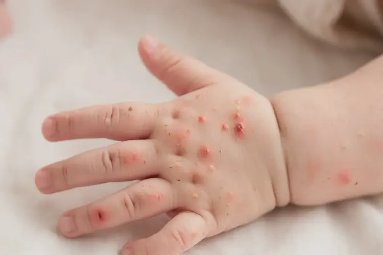 寶寶手上出現(xiàn)濕疹不管它會自己好嗎(圖3)