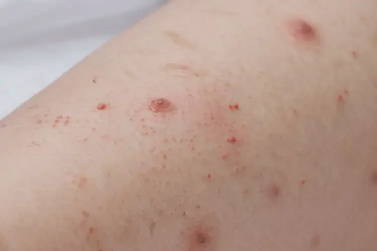 儿童大腿经常长湿疹可不可以彻底自愈(图4)