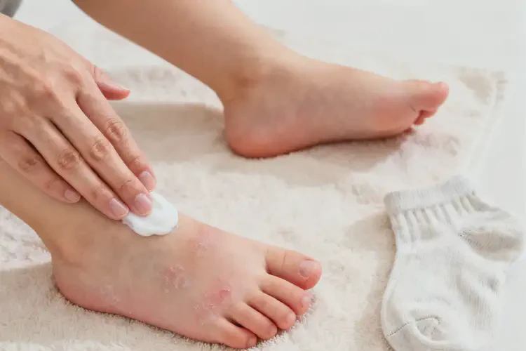 孩子腳上經(jīng)常起濕疹能靠自己自愈嗎(圖1)