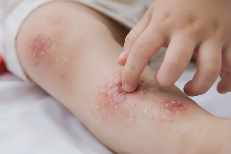 兒童小腿上起濕疹可不可以徹底自愈(圖4)