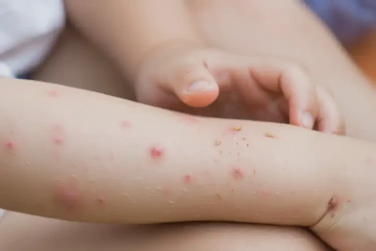 小學(xué)生四肢出濕疹不管它會(huì)自己痊愈嗎(圖4)