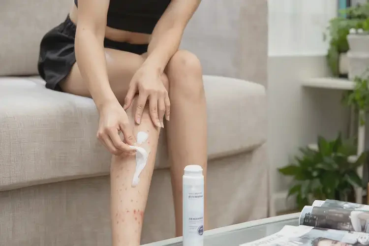 女性大腿上長濕疹可以徹底自愈嗎(圖2)