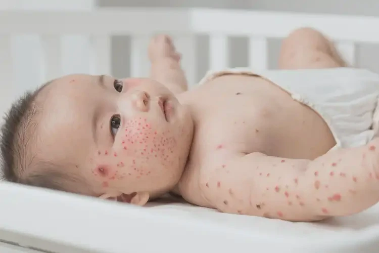 嬰幼兒全身經(jīng)常起濕疹可以徹底自愈嗎(圖4)