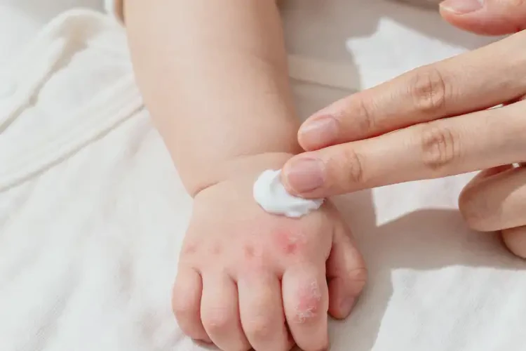 嬰兒手上出濕疹能靠自己自愈嗎(圖3)