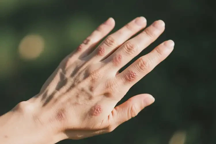 女生手上偶爾長濕疹不管它會自己自愈嗎(圖2)