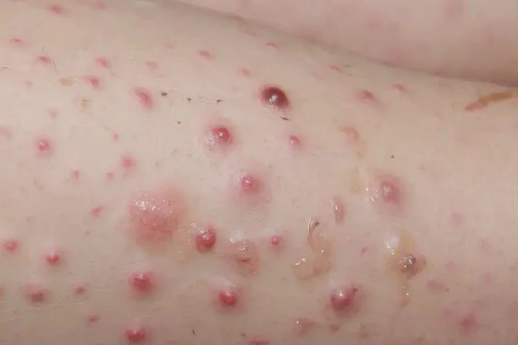 孩子小腿容易起濕疹不管它會(huì)自己自愈嗎(圖4)