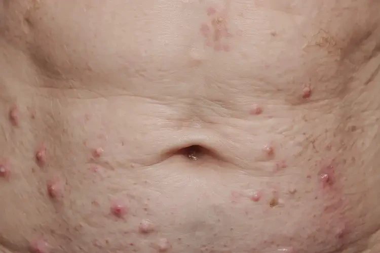 老年人肚子出濕疹能不能徹底自愈(圖4)