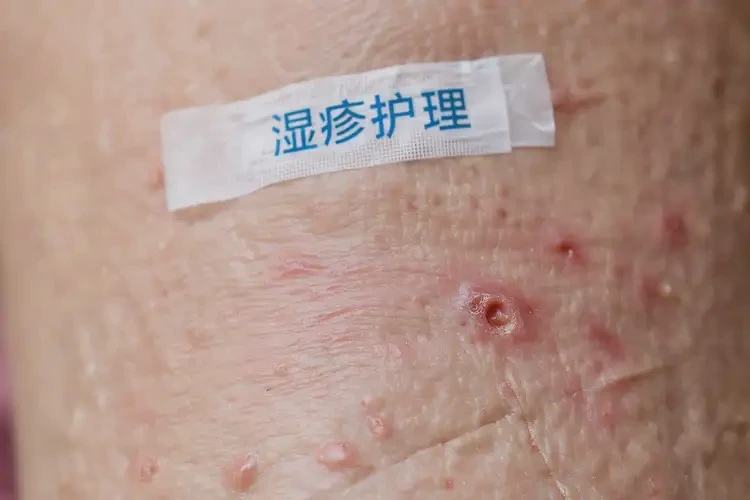 老年人身上偶爾起濕疹能徹底自愈嗎(圖4)