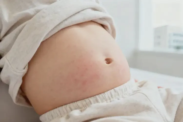 兒童肚子偶爾長濕疹不管它會自己好嗎(圖3)