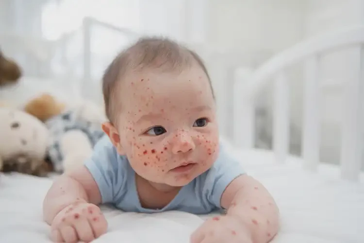 寶寶屁股上經(jīng)常起濕疹能靠自己自愈嗎(圖4)