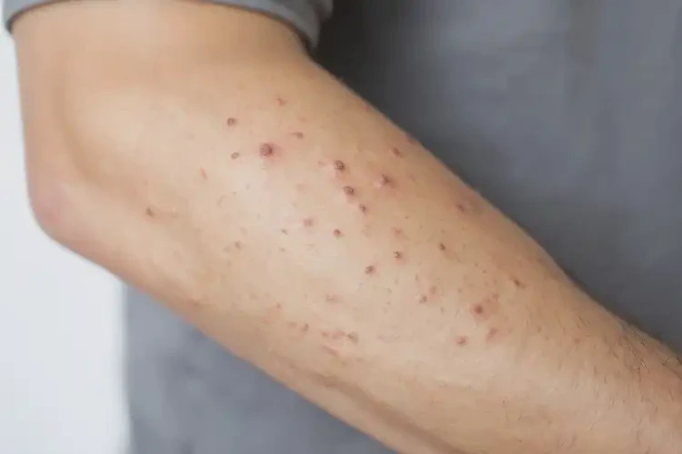 青年人手臂出濕疹可不可以徹底自愈(圖3)