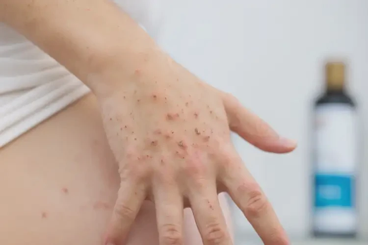 孕婦手上偶爾長濕疹不管它會自己自愈嗎(圖4)