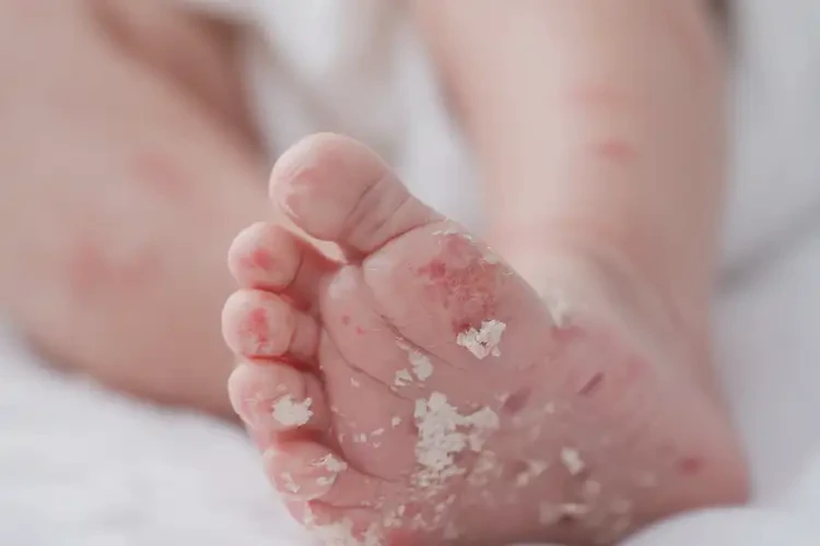 新生兒腳上經(jīng)常起濕疹不管它會(huì)自己好嗎(圖4)