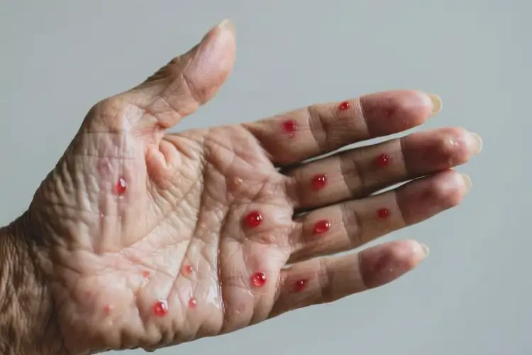 老人手上經(jīng)常起濕疹不管它會(huì)自己痊愈嗎(圖3)