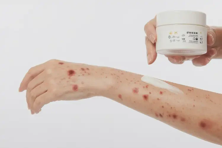 女性手臂上偶爾長(zhǎng)濕疹可以徹底自愈嗎(圖2)