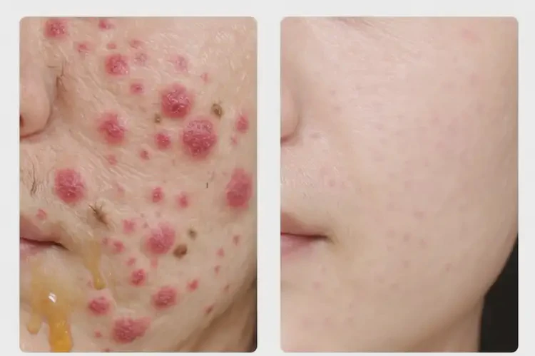 大學(xué)生屁股上偶爾起濕疹不管它會(huì)自己自愈嗎(圖2)