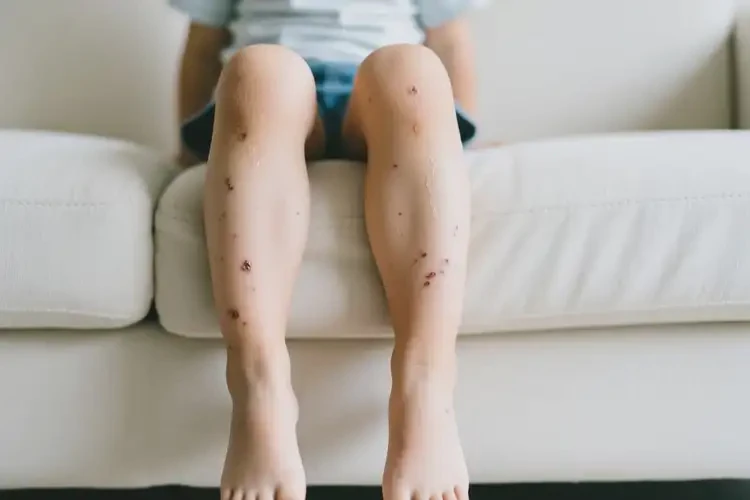 少兒大腿上偶爾起濕疹不管它會自己好嗎(圖3)