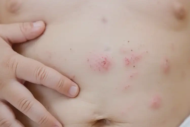 寶寶肚子上有濕疹不管它會(huì)自己好嗎(圖4)