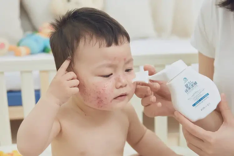 幼兒面部容易起濕疹能夠徹底治愈嗎(圖4)