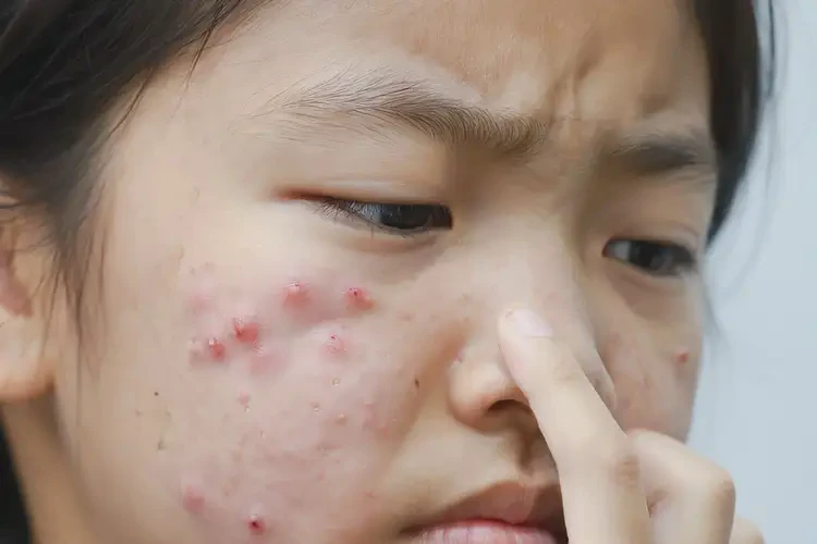 中學(xué)生臉上有濕疹可不可以徹底自愈(圖4)