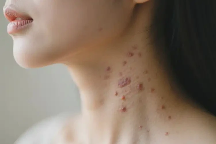 女人脖子上出現(xiàn)濕疹不管它會(huì)自己好嗎(圖4)