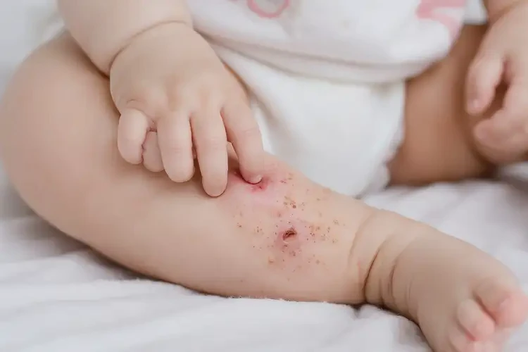 小兒大腿長(zhǎng)濕疹可以徹底自愈嗎(圖4)