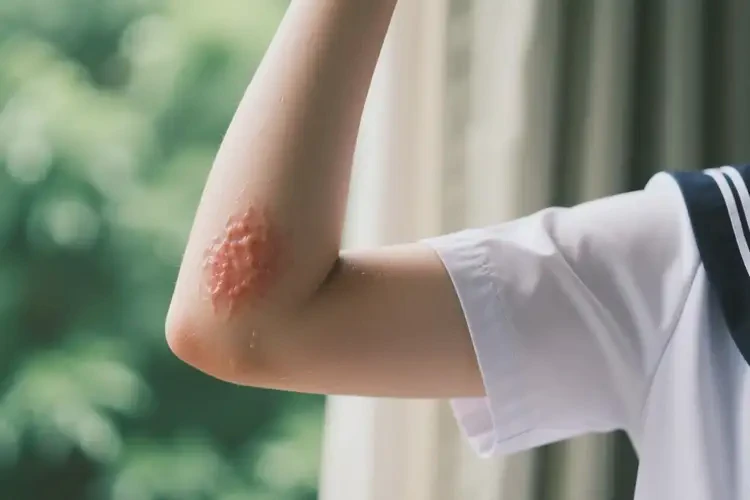 大學生四肢長濕疹不管它會自己自愈嗎(圖4)