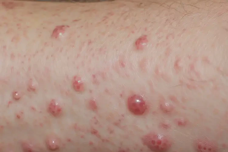 大学生脚上出湿疹不管它会自己痊愈吗(图3)