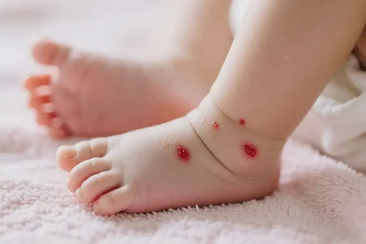 新生兒腳上出濕疹不管它會(huì)自己自愈嗎(圖3)