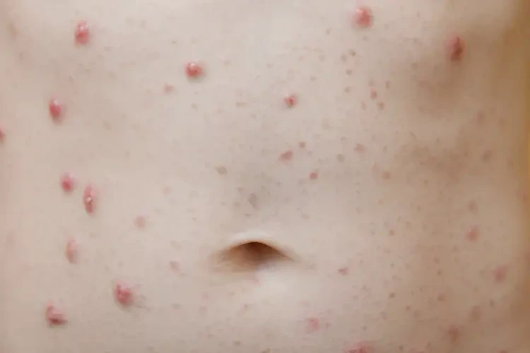 小學(xué)生肚子偶爾長(zhǎng)濕疹能徹底自愈嗎(圖4)