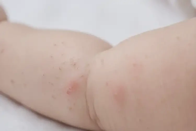 寶寶手臂上偶爾起濕疹不管它會(huì)自己痊愈嗎(圖4)