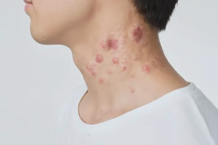 青年人脖子經(jīng)常起濕疹不管它會自己好嗎(圖4)