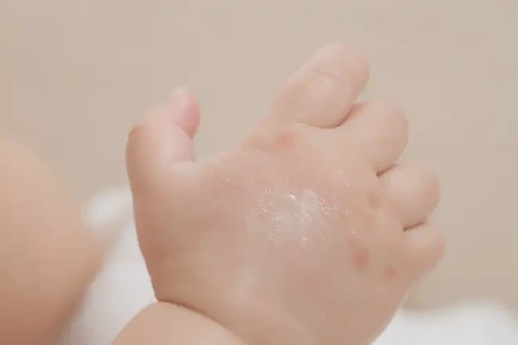 寶寶手上出現(xiàn)濕疹不管它會自己好嗎(圖1)