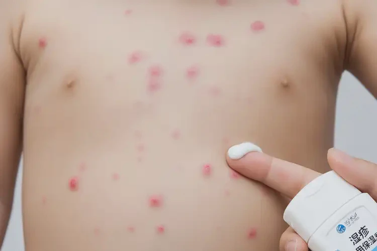 小孩肚子上有濕疹能徹底自愈嗎(圖3)